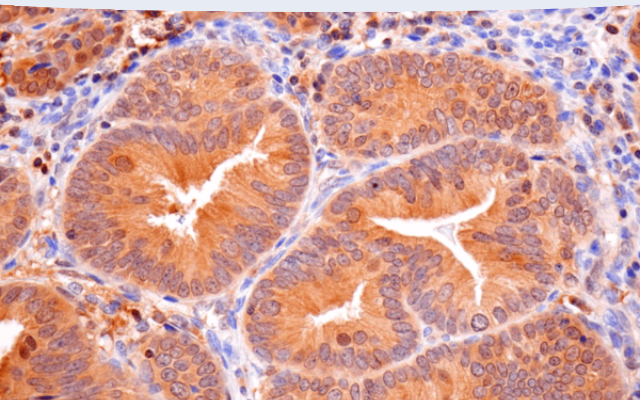 Immunohistochemical analysis of paraffin-embedded human endometrioid adenocarcinoma using Caspase-8 (F5K9P) Rabbit mAb #8873.