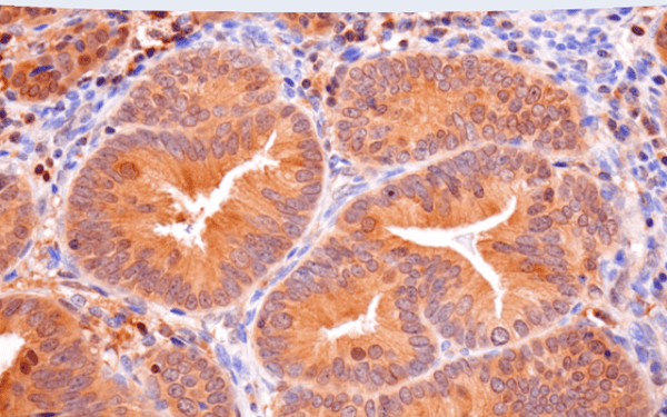 Immunohistochemical analysis of paraffin-embedded human endometrioid adenocarcinoma using Caspase-8 (F5K9P) Rabbit mAb #8873.
