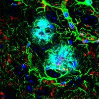 Confocal IF analysis of fixed frozen mouse brain from an amyloid mouse model of Alzheimer’s disease labeled with the antibodies described above and ProLong Gold Antifade Reagent with DAPI #8961 (blue).