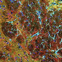 Phospho-Tau (Thr205)(E8Q5Z) (green), GFAP (cyan), β3-Tubulin (red), DAPI (blue)