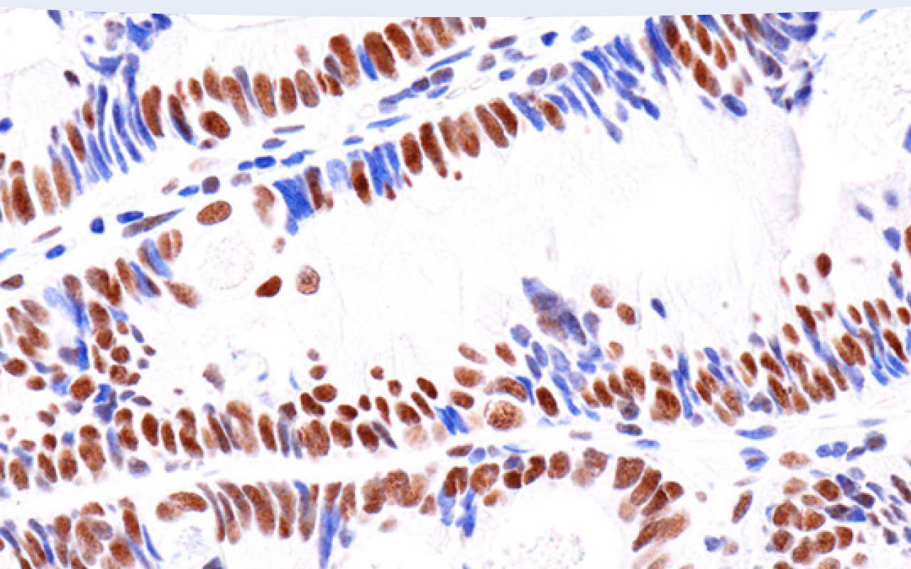 Immunohistochemical analysis of paraffin-embedded human colon carcinoma using ATRX (E5X7O) Rabbit mAb.