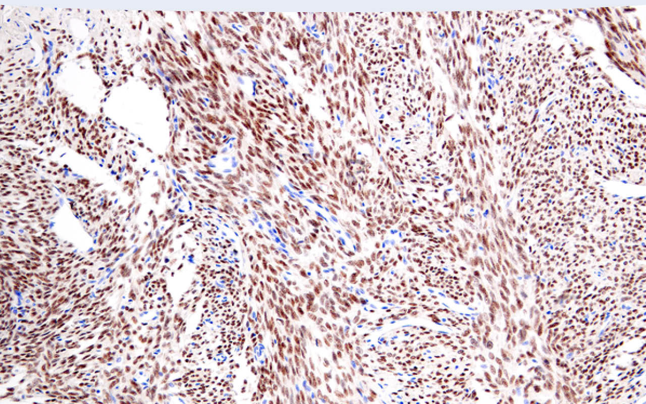 Immunohistochemical analysis of paraffin-embedded human synovial sarcoma using SS18-SSX (E9X9V) XP® Rabbit mAb performed on the Leica® BOND™ Rx.