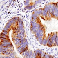 Immunohistochemical analysis of paraffin-embedded human colon adenocarcinoma using Bim (C34C5) Rabbit mAb performed on the Leica® BOND™ Rx.