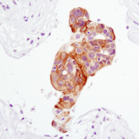 Immunohistochemical analysis of paraffin-embedded human lung carcinoma