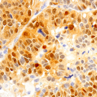 Immunohistochemical analysis of paraffin-embedded human urothelial carcinoma.