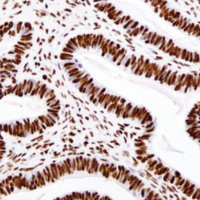 Immunohistochemical analysis of paraffin-embedded ovarian serous carcinoma using Acetyl-Histone H3 (Lys18) (D8Z5H) Rabbit mAb.