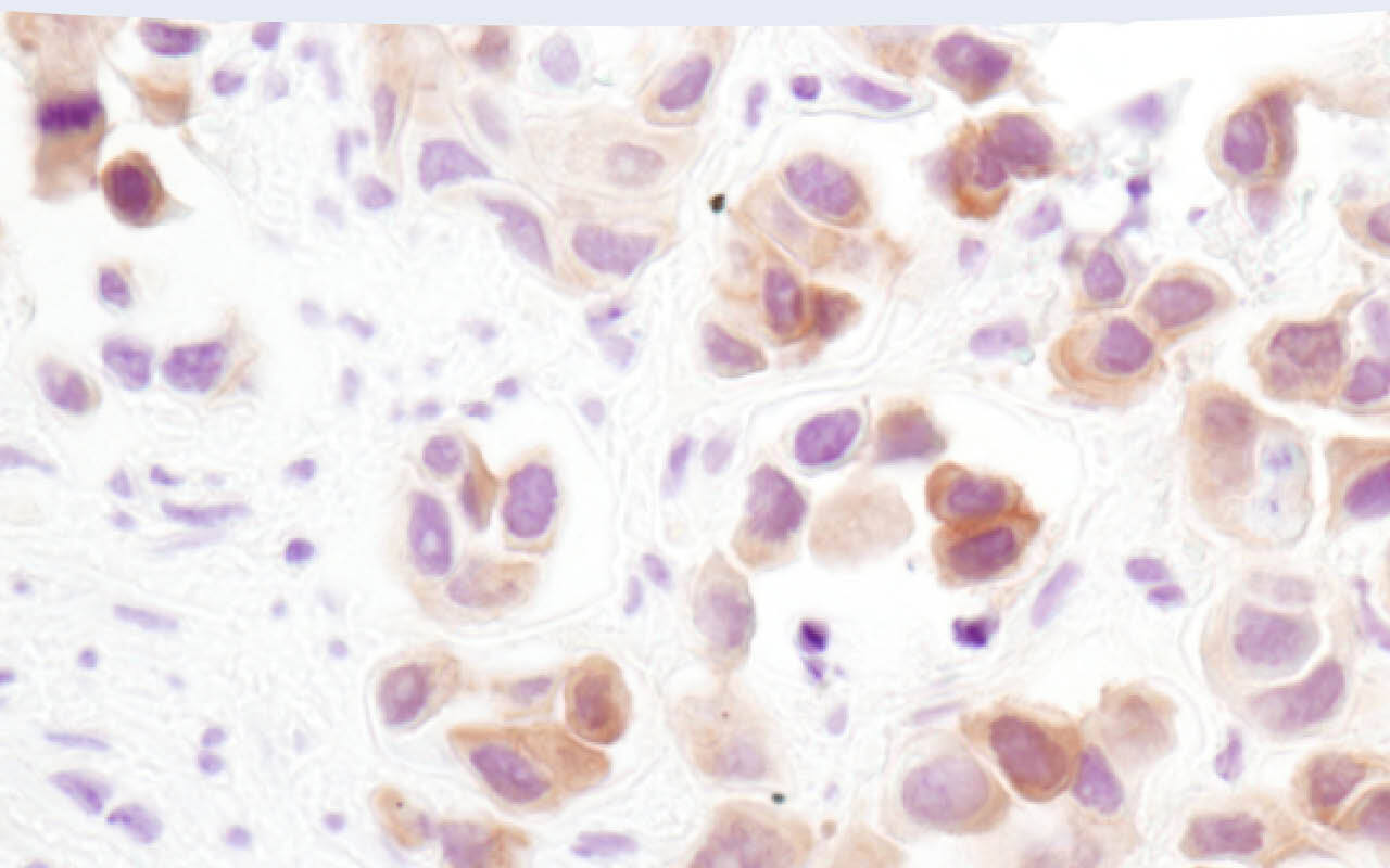 Immunohistochemical analysis of paraffin-embedded MDA-MB-468 xenograft using Phospho-Akt (Ser473) (D9E) XP® Rabbit mAb or PTEN (138G6) Rabbit mAb #9559. Image shows the presence of P-Akt staining in the PTEN deficient MDA-MB-468 cells.