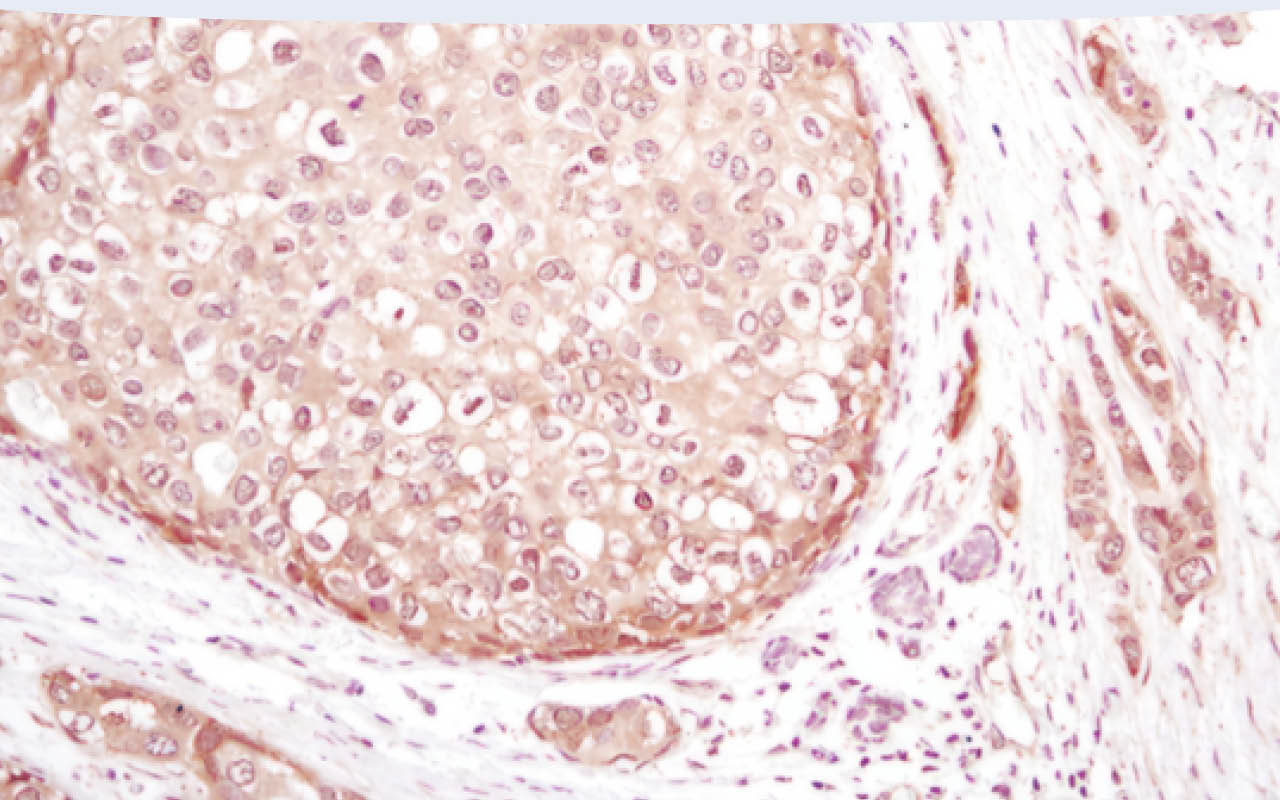Immunohistochemical analysis of paraffin-embedded human breast carcinoma using Akt (pan) (C67E7) Rabbit mAb in the presence of control peptide or Akt (pan) Blocking Peptide #1085.