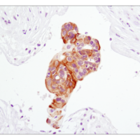 Immunohistochemical analysis of paraffin-embedded human lung carcinoma using Phospho-Akt (Ser473) antibody.