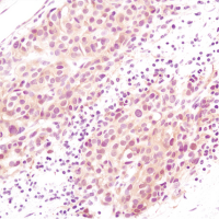 Immunohistochemical analysis of paraffin-embedded human melanoma using Akt (pan) (C67E7) Rabbit mAb.