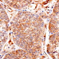 Immunohistochemical analysis of paraffin-embedded human squamous cell lung carcinoma using PTEN (138G6) Rabbit mAb performed on the Leica BOND RX.