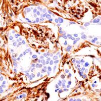 Immunohistochemical analysis of paraffin-embedded human ductal breast carcinoma using FTH1 antibody.
