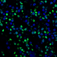 Immunofluorescence analysis of human colon carcinoma using the CST TUNEL Assay Kit and Cleaved Caspase-3 (Asp175) antibody.