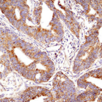 Immunohistochemical analysis of paraffin-embedded human colon carcinoma using Bak antibody.