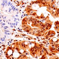 Immunohistochemical analysis of paraffin-embedded human esophageal adenocarcinoma using PTEN antibody.