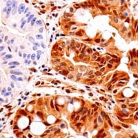Immunohistochemical analysis of paraffin-embedded human esophageal adenocarcinoma using PTEN antibody.
