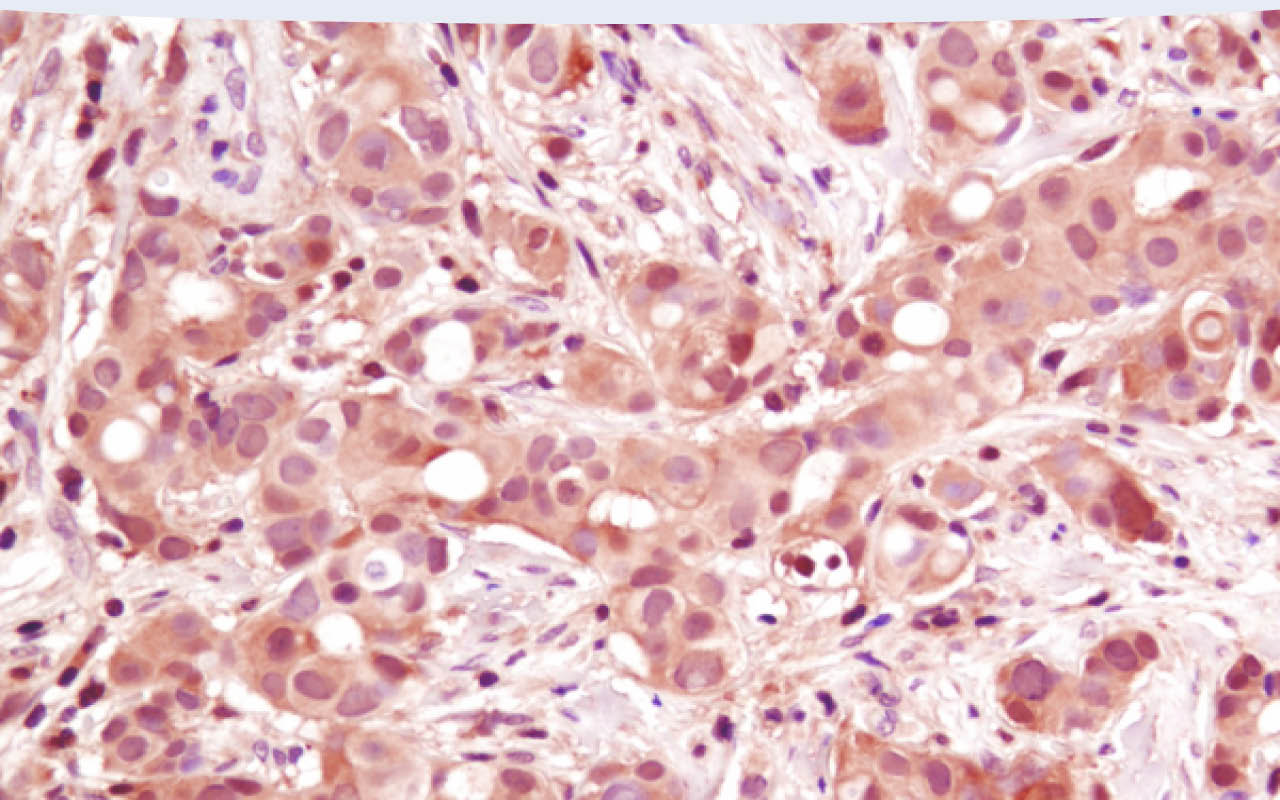 Immunohistochemical analysis of paraffin-embedded human breast carcinoma using p38 MAPK (D13E1) XP® Rabbit mAb.