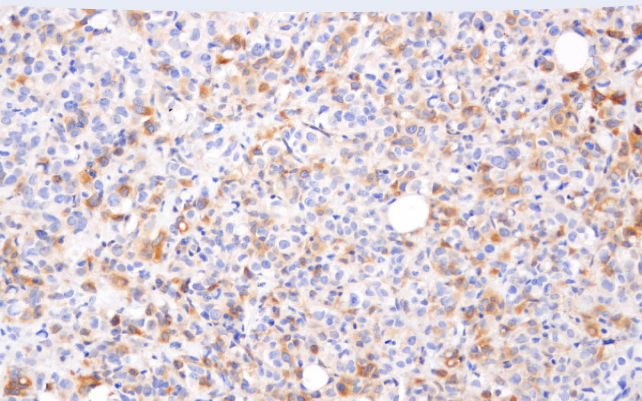 Immunohistochemical analysis of paraffin-embedded human breast carcinoma using Phospho-AMPKα (Thr172) (40H9) Rabbit mAb.