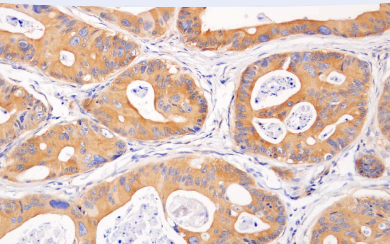 Immunohistochemical analysis of paraffin-embedded human colon carcinoma using Phospho-AMPKα (Thr172) (40H9) Rabbit mAb.