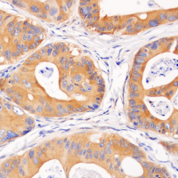 Immunohistochemical analysis of paraffin-embedded human colon carcinoma using Phospho-AMPKα (Thr172) (40H9) Rabbit mAb.