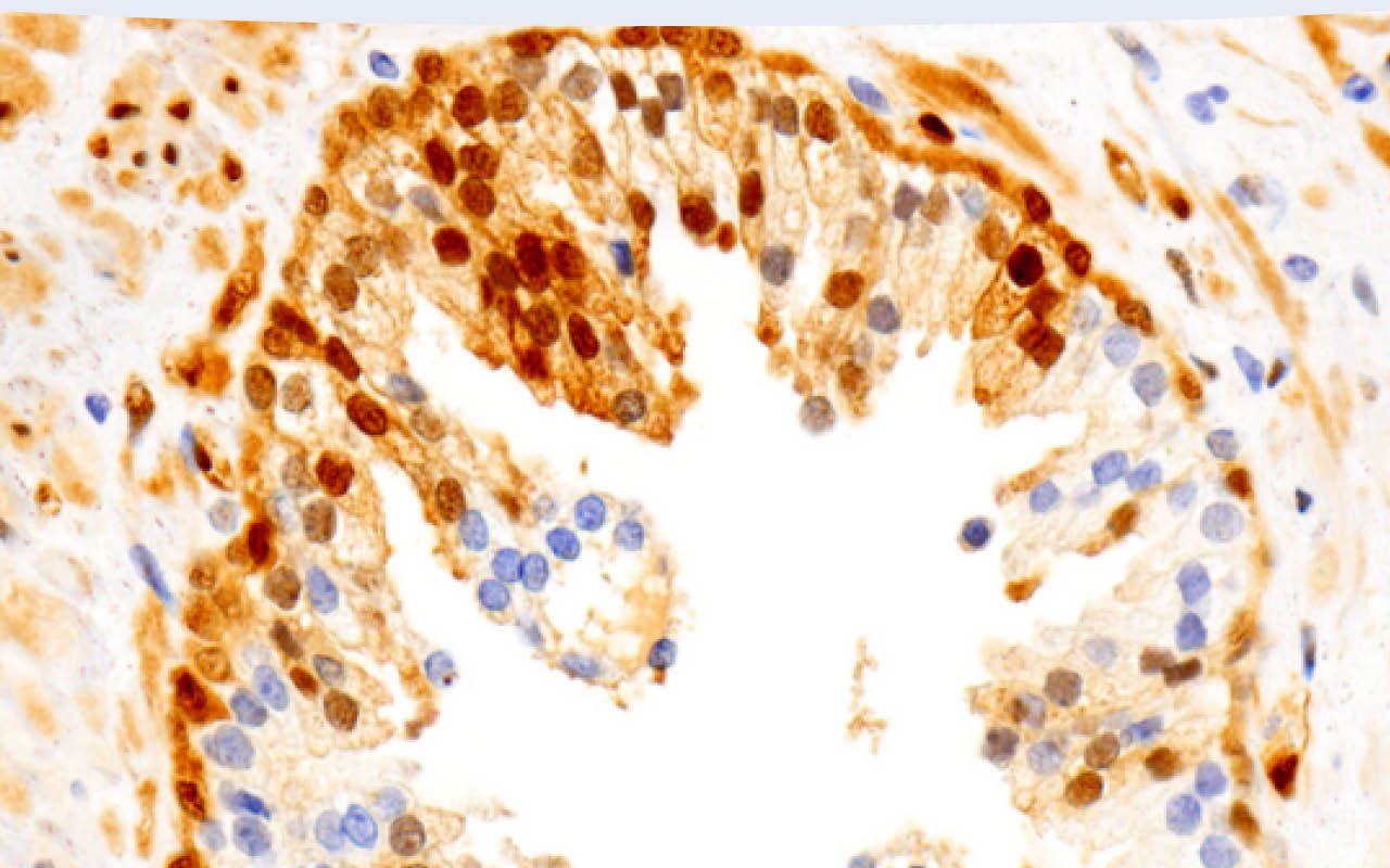 Immunohistochemical analysis of paraffin-embedded human prostate adenocarcinoma using Phospho-p44/42 MAPK (Erk1/2) (Thr202/Tyr204) (D13.14.4E) XP® Rabbit mAb performed on the Leica BOND RX.