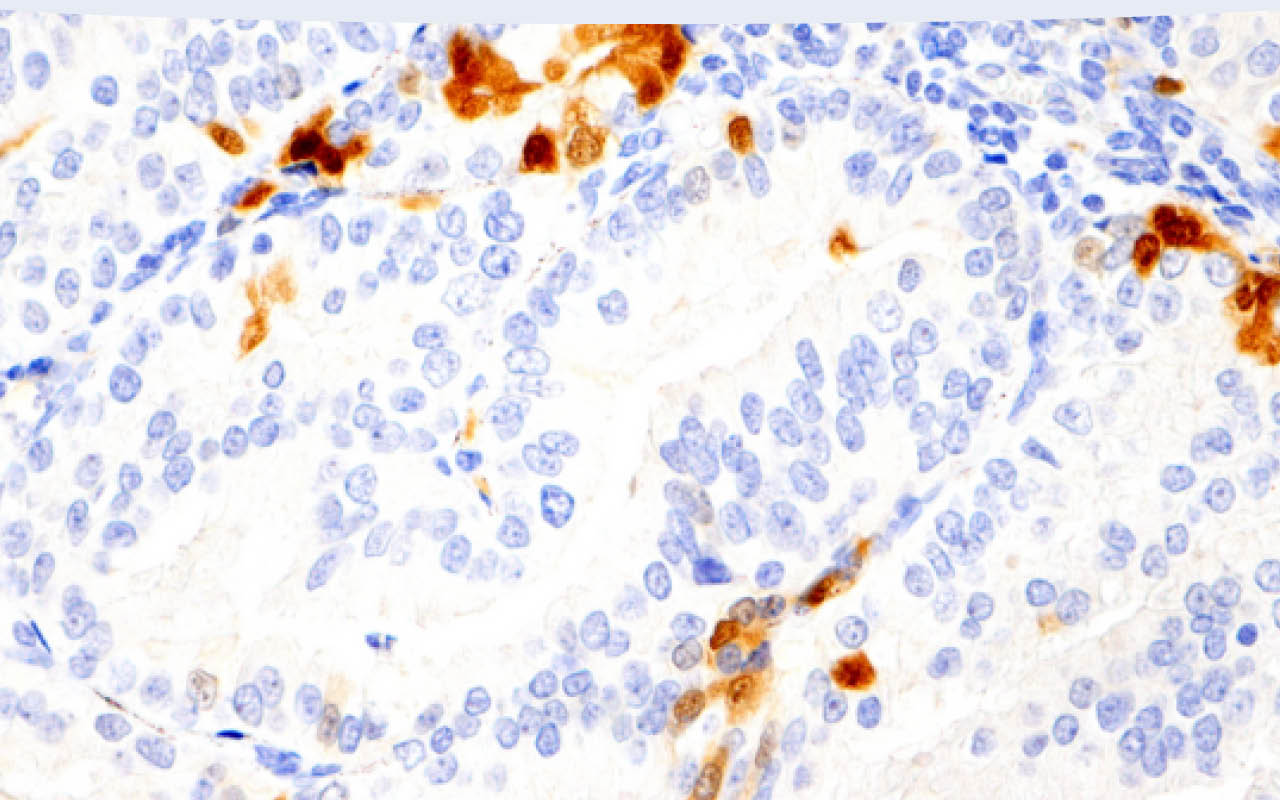 Immunohistochemical analysis of paraffin-embedded human endometrioid adenocarcinoma using Phospho-p44/42 MAPK (Erk1/2) (Thr202/Tyr204) (D13.14.4E) XP® Rabbit mAb performed on the Leica BOND RX.