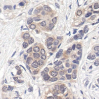 Immunohistochemical analysis of paraffin-embedded human breast carcinoma, showing cytoplasmic and nuclear localization, using p44/42 MAPK (Erk1/2) (137F5) Rabbit mAb.