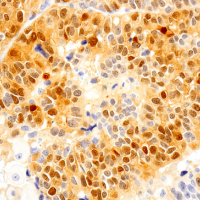 Immunohistochemical analysis of paraffin-embedded human urothelial carcinoma using Phospho-p44/42 MAPK (Erk1/2) (Thr202/Tyr204) (D13.14.4E) XP® Rabbit mAb performed on the Leica BOND RX.