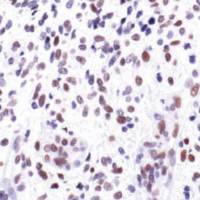 Immunohistochemical analysis of paraffin-embedded human astrocytoma, using c-Jun (60A8) Rabbit mAb.