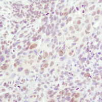 Immunohistochemical analysis of paraffin-embedded human lung carcinoma using Phospho-SAPK/JNK (Thr183/Tyr185) (81E11) Rabbit mAb in the presence of control peptide and Phospho-SAPK/JNK (Thr183/Tyr185) Blocking Peptide #1215.