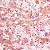 Immunohistochemical analysis of paraffin-embedded human breast carcinoma using p38 MAPK (D13E1) XP® Rabbit mAb.