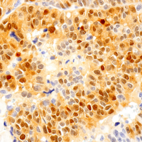 Immunohistochemical analysis of paraffin-embedded human urothelial carcinoma using Phospho-p44/42 MAPK (Erk1/2) (Thr202/Tyr204) (D13.14.4E) XP® Rabbit mAb performed on the Leica BOND RX.