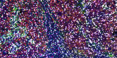 SignalStar® multiplex immunohistochemical analysis of paraffin-embedded human gastric adenocarcinoma