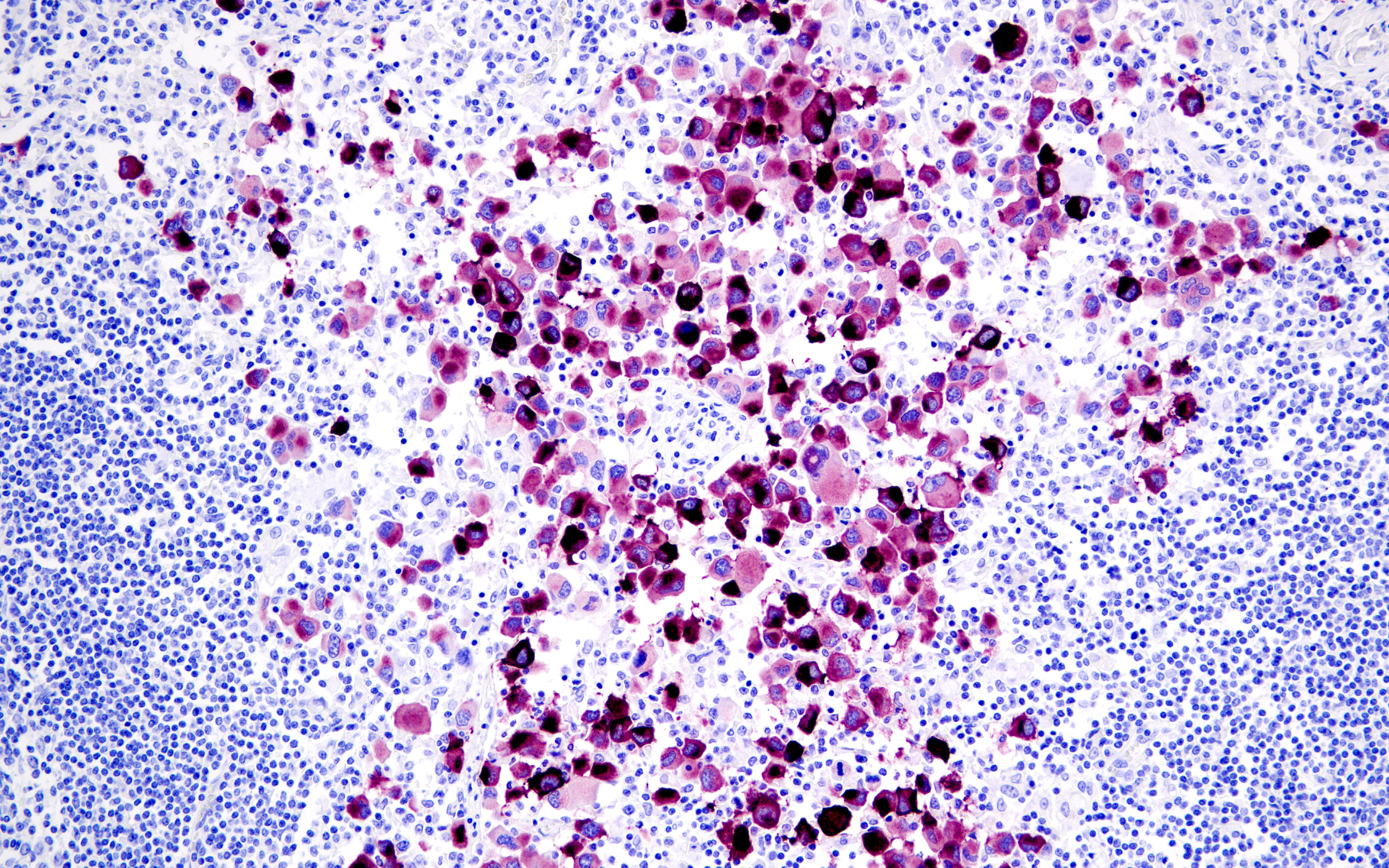 Cancer melanoma research