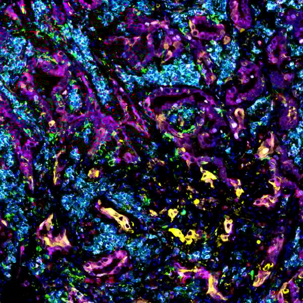 SignalStar® multiplex immunohistochemical analysis of paraffin-embedded human lung adenocarcinoma.